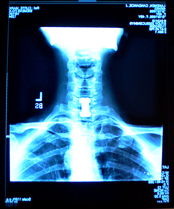 X-ray of Candy's repaired spinal column along with her new dogbone-shaped titanium plate. (2005)