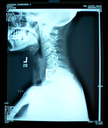 Profile x-ray of Candy's repaired neck.  The thumbnail zooms in on the sideview of the titanium plate.  (2005)